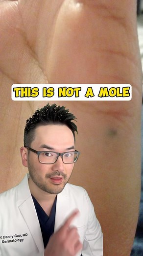 Dr. Danny Guo | Dermatologist on Instagram: "This is not a mole. It’s a graphite tattoo which literally happens because pencil graphite got stuck deep in the skin. These can sometimes be removed with laser but may require a small surgical procedure. #dermatologist #skincare #skincarecommunity #tattoo #penciltattoo"