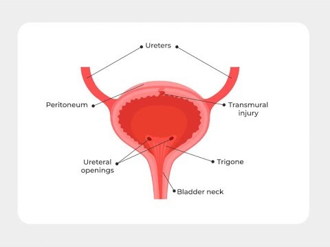 Bladder perforation Or bladder rupture (Bladder wall is torn); Causes, symptoms, Diagnosis, treatmen