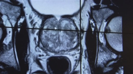 Doctors urge men to check for prostate cancer