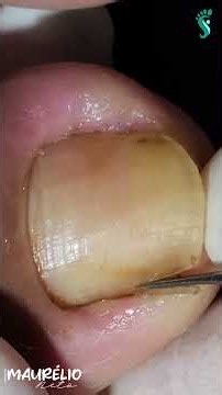 Antibiótico não resolveu: o problema tava DEBAIXO da unha #podologomaurelio#satisfyingvideos #shorts