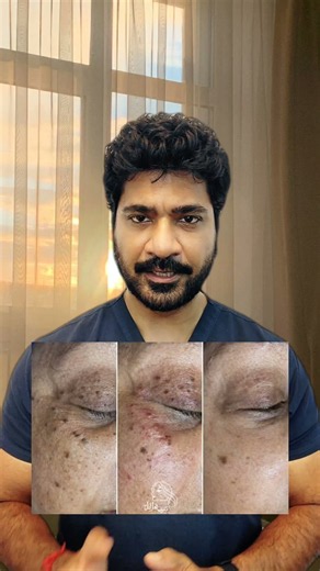 How to remove SKIN TAG Safely? #skincare #skintags #skintagremoval