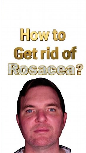 How to Get Rid of Rosacea with BBL Laser | Real Results at KAADO MD