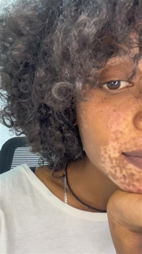 The journey toward self acceptance can be daunting, Especially when society imposes its narrow standards of beauty upon us. But remember the most profound beauty emerges from embracing our flaws and celebrating our individuality. You are not defined by the color of your skin but by the kindness of your heart and the strength of your spirit.🌸