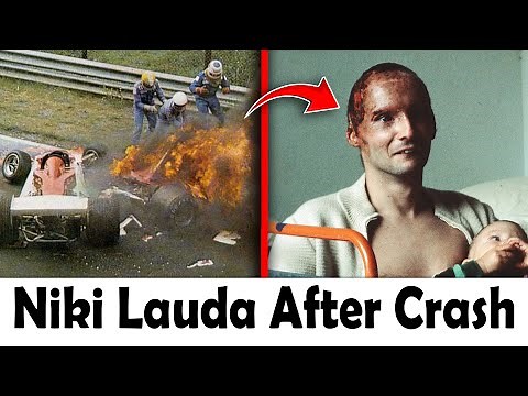 Niki Lauda Crash in Nürburgring Accident | Niki Lauda’s Face Before and After Accident
