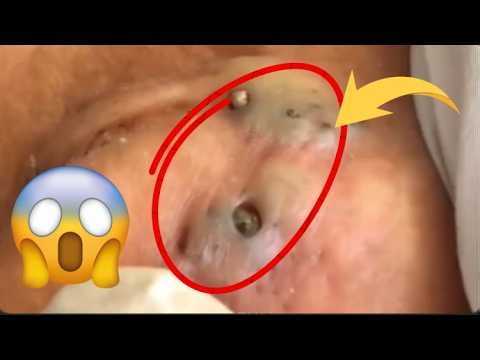 HUGE Blackheads Removed One by One — So Satisfying!