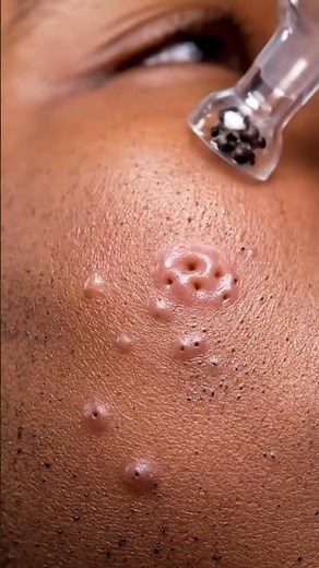 Nose Pore Blackhead Removal — Smooth