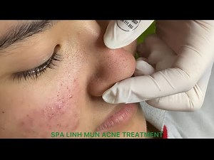 Acne treatment under the skin #006 / Spa Linh Mun