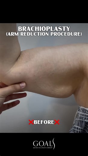 Goals Plastic Surgery | Saggy arms? “Bat wings”? Extra skin after weight loss or aging? 👀 Our Arm Lift (Brachioplasty) procedure is designed to: ✅ Remove excess... | Instagram