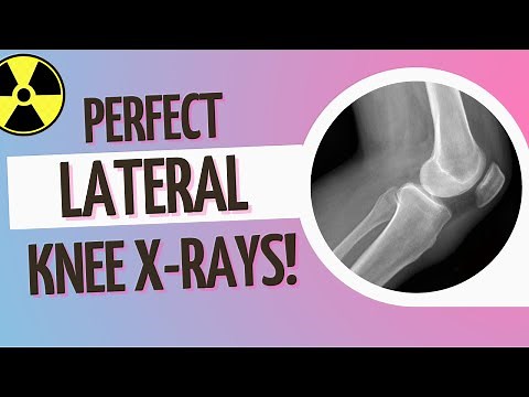 Perfect Lateral Knee X-Ray Positioning Tips (Incl. Lateral Notch at 4:00)