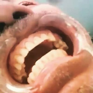 18K views · 358 reactions | Alveolar Bone Fracture  | Dr.Sreenath S | Facebook