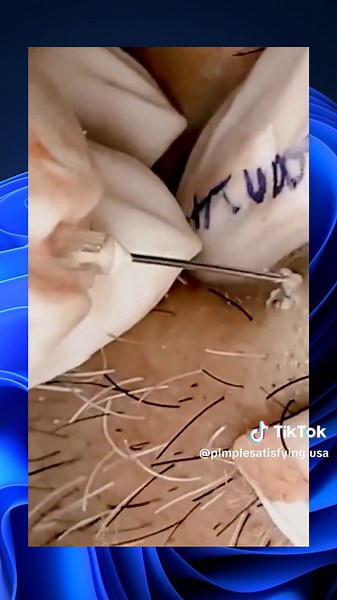 skincare squeeze pimple satisfying extraction explore popping (502)