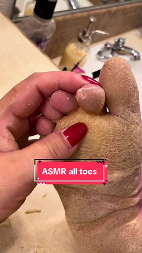 ASMR Toe Cleaning and Callus Removal with Satisfying Sounds