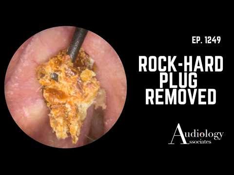 Rock-Hard Keratin Plug Pressed Against the Eardrum – Carefully Removed - EP1249