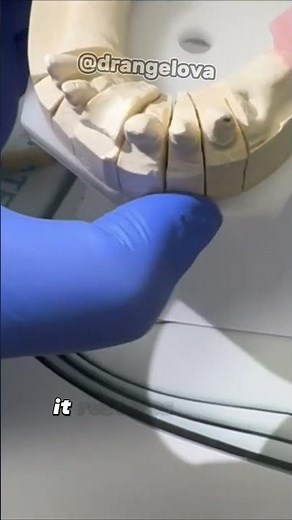 Porcelain Bonded Bridge for Upper Front Teeth 🦷