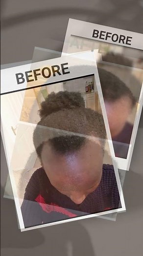 Before and After using The Ordinary Multi-Peptide Serum for Hair Density. #hairlosssolutiion