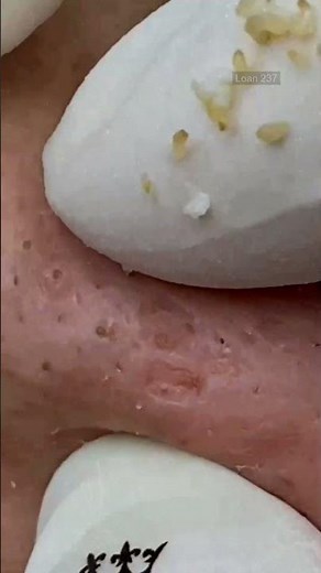 The best pimples, hands down