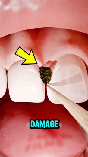 STOP Using Toothpicks! 😱 This Simple Habit Is Damaging Your Gums Use This Instead!