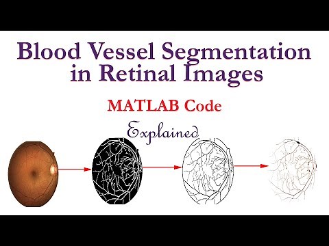 Blood Vessel Segmentation in Retinal Images using MATLAB