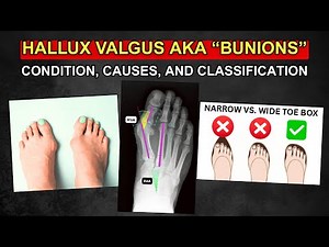 Hallux Valgus (Part 1) - Condition, Causes, and Classification