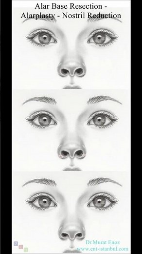 Alar Base Resection - Alarplasty Nostril Reduction #AlarBaseResection #Alarplasty #NostrilReduction
