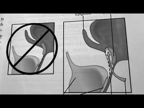 POSTERIOR HYOID SPACE (CORE CONCEPT OF SISTRUNK OPERATION)