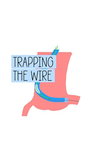 Don’t Miss A Beat ®️ on Instagram: "Basic Trapping: What is it? Think of pinning the wire from inside the guide catheter. Many uses but here are a few: - Removing a microcatheter off of a short shaft wire - Advancing a microcatheter over a short shaft wire - Pinning a retrograde wire from CTO crossing, that you want to externalize I’ve seen some uses for interesting complications 👀 What other uses have you seen?"