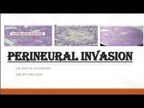 Perineural Invasion SCC || Simplified explanation || Images