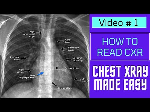 Chest Xray Made Easy || How to read CXR || Video 1