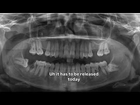 Extraction of broken down lower Molar tooth