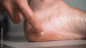 Close-Up View of Blister on Heel with Detailed Skin Texture and Swelling. Inspecting a foot and touching a large painful blister.