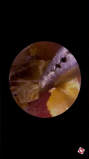 Years of Ear Discomfort Solved After This Satisfying Earwax Removal Must See Video