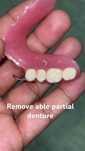 Remove able partial denture 😬😬😬#apexdental #dentistry #partialdenture #orthodontist #splittooth