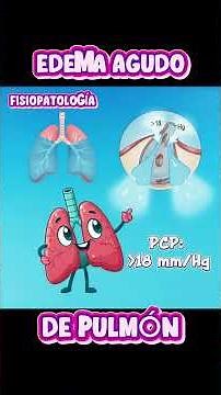 EDEMA AGUDO DE PULMÓN RESUMEN ANIMADO#enarm #gpc #doctor #pulmonology