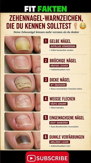 Diese Zehennagel-Veränderungen solltest du nicht ignorieren 👣😳 #fitfakten