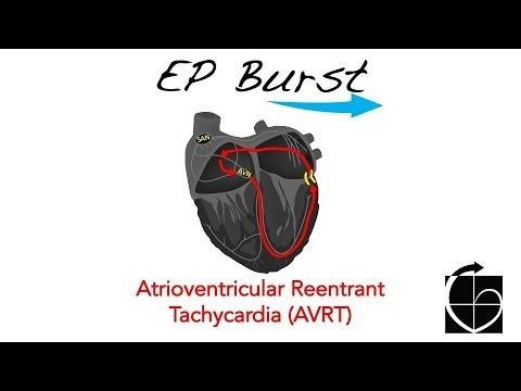 EP Burst: AVRT | CHART Healthcare Academy