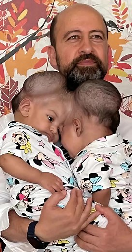 😨😱 Conjoined twins with fused brains separated after a 14-hour surgery. See what they look like now. The medical world held its breath: something happened that until recently seemed impossible. The one-year-old conjoined twins, Minal and Mirha, born with joined heads and shared brain vessels, were successfully separated after a risky operation lasting nearly 14 hours. An international team of surgeons fought for the girls’ lives. 😲😲 Two months after the surgery, the little ones returned home