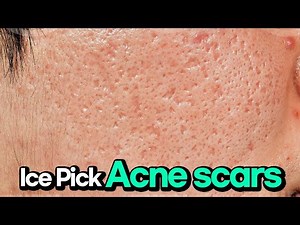 Deep Acne Scars Solved: Ice Pick Scar Laser Treatment Explained