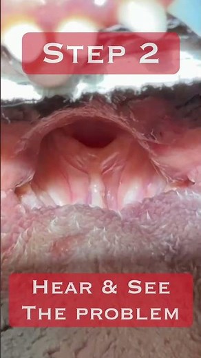 Elongated Soft Palate Laser Surgery Steps