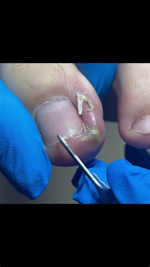 Amazing Toenail Trimming... #pedicure #toenails