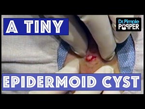 A small but annoying Cyst on the Back
