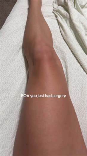 Send help both my legs are goners 😭😭 #goodbye #muscle #surgery #atrophy #rip