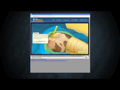 Virtual Hip Replacement
