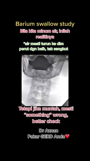 Understanding GERD Symptoms and Anxiety: Expert Insights