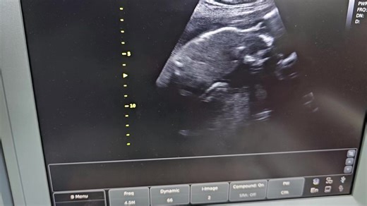 Affordable Twin Ultrasound Services in Your Area