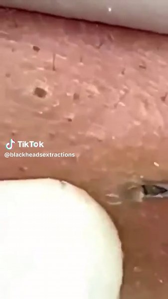 #Blackheads #fyp #satisfyingvideos #parati #viral | black dots removal