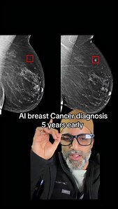 Breast cancer diagnosed by artificial intelligence 5 years early. AI gives the ability to go back and look at all your scans simultaneously in minutes, what would take radiologist 10-20x as long, the future is bright. #radiologist #breastcancer | Zain Hasan