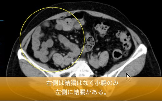 中腸回転異常とは？CT画像の特徴は？エコーは？