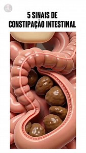 5 SINAIS DE CONSTIPAÇÃO INTESTINAL: 1- Dificuldade para evacuar: Sente que não consegue ir ao banheiro facilmente ou precisa se esforçar muito para evacuar. 2- Fezes duras e ressecadas: Quando as fezes saem muito secas, em pedaços ou difíceis de eliminar. 3- Barriga inchada e desconforto: Sensação de plenitude, inchaço e desconforto, como se a barriga estivesse sempre cheia. 4- Menos de 3 evacuações por semana: Se você vai ao banheiro com pouca frequência, ou menos de 3 vezes por semana. 5- Evac