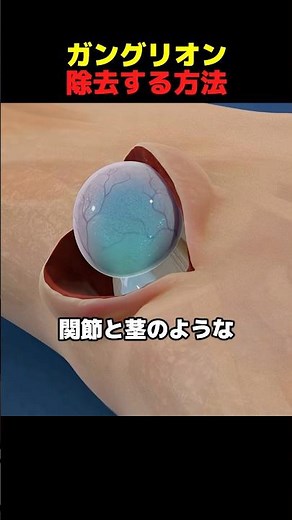 ガングリオン除去する方法