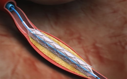 原创科普医学动画连载003—冠脉介入治疗手术过程